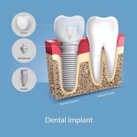 Diagram showing how the crown, abutment, and screw fit together to form a complete dental implant that takes the place of a natural tooth.