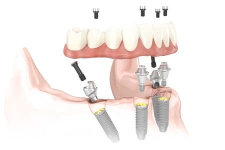 A diagram of an implant overdenture being attached onto four dental implants according to the All-on-4 technique. The screws and abutments are angled in a specific way.