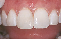 A photo showing the results of a smile makeover done with dental bonding.