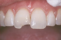 A photo of a smile taken prior to the completion of a makeover done with dental bonding.