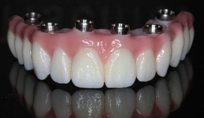 A photo of the upper jaw portion of a set of hybrid implant overdentures. This hybrid denture is designed to replace the missing teeth and gum tissue and securely attach to six implants in the upper jawbone.