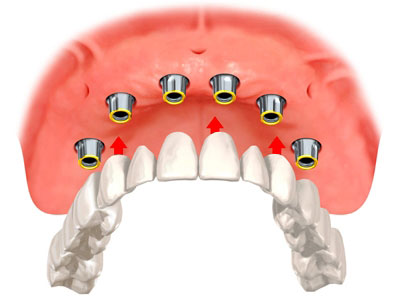A diagram of an implant bridge that uses six implants to attach a full, connected upper set of teeth.