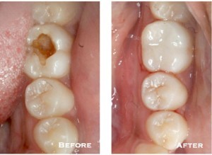 A tooth with a cavity is shown before and after restoration with a mercury-free filling at the dentist.
