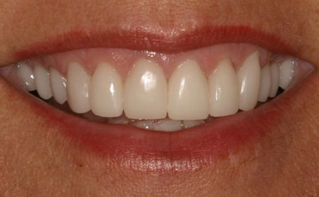 A photo of a smile with four beautiful porcelain crowns on the front teeth. These crowns blend in seamlessly with the surrounding teeth.