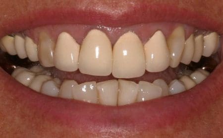 A photo of a smile restored by four porcelain-fused-to-metal crowns on the top front teeth. These crowns are more opaque than the surrounding teeth, and dark lines are visible above them.
