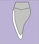 A drawn diagram of a porcelain veneer on a tooth.