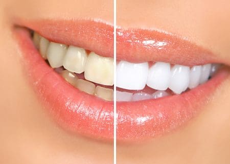 Image of a woman's smile that compares the look of her teeth before and after teeth whitening.