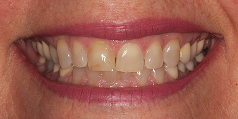 cathy-t-teeth-before