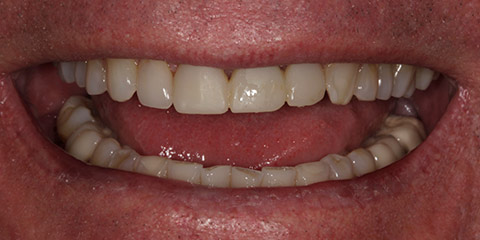 dan-l-teeth-before