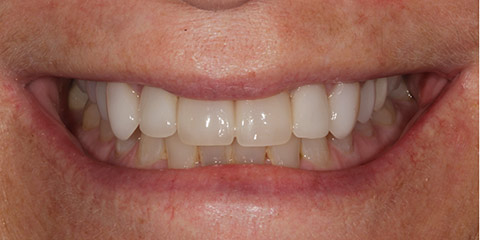 deborah-s-teeth-before