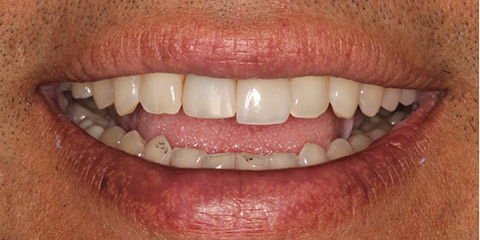 ed-k-teeth-before