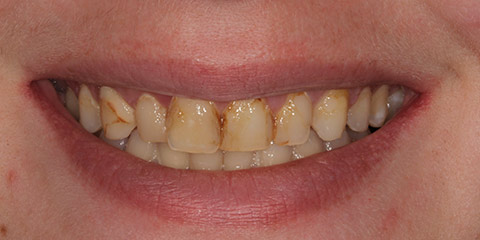 emily-m-teeth-before
