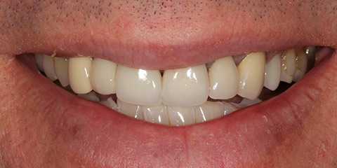 jason-m-teeth-before
