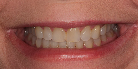 vickie-v-teeth-before