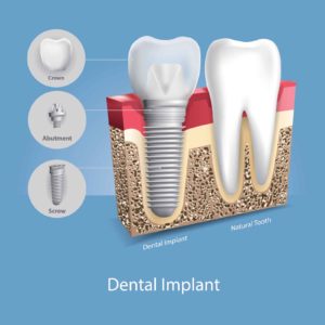 An illustration of a dental implant next to a natural tooth