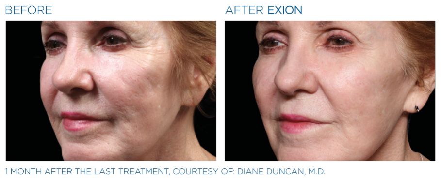 Side-by-side before and after photos showing the results one female patient experienced through treatment with Exion Radiofrequency Microneedling.