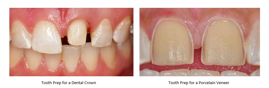 Porcelain veneer versus dental crown prep on teeth.