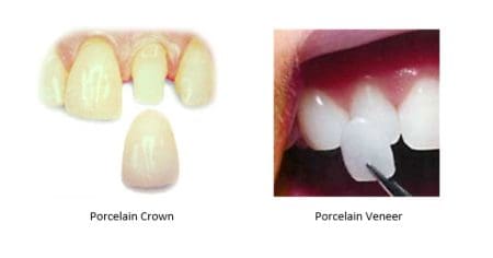 Dental crowns beside porcelain veneers